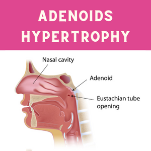 adenoids Hypertrophy 